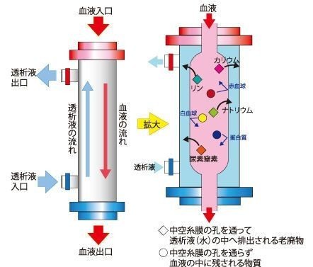 人工透析の仕組み やすみっち Note 人工透析の仕組み やすみっち Note