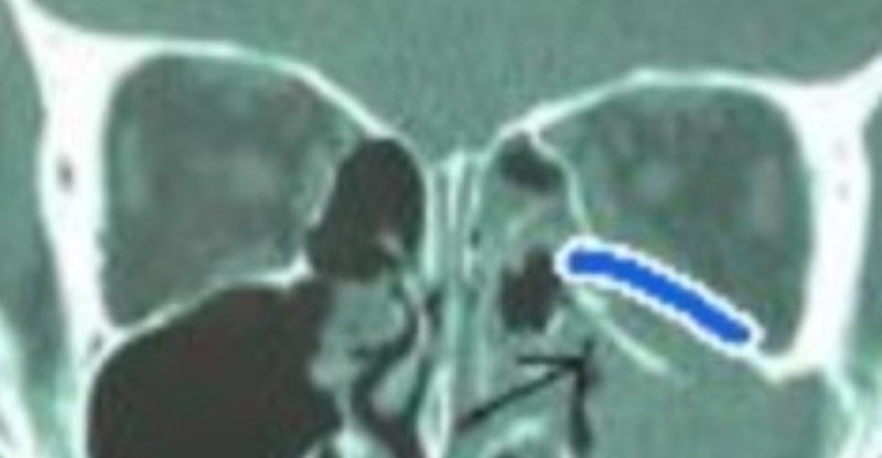 眼窩 底 骨折 と は