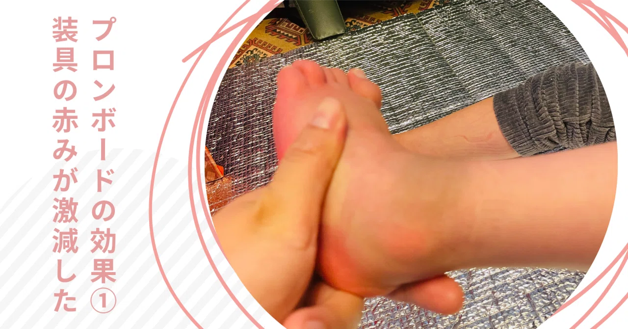 Effects of the Prone Board ①: Significant Reduction in Orthosis 
