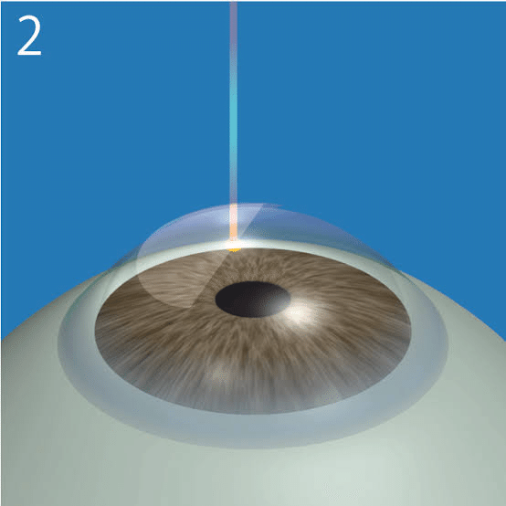 2025年最新版】乱視は治る？治療法から矯正手術、生活改善まで徹底解説