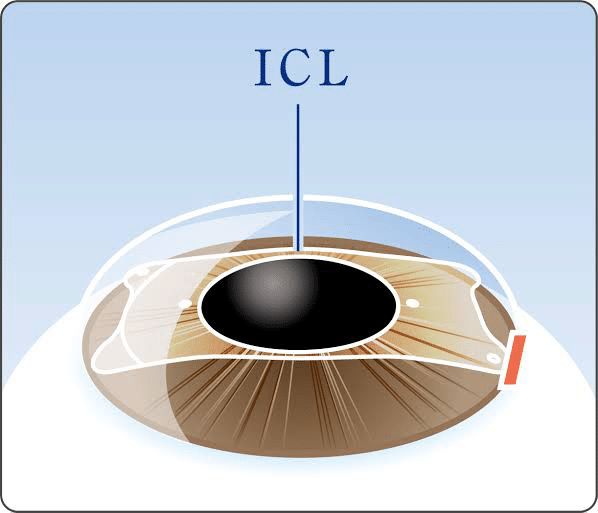 2025年最新版】乱視は治る？治療法から矯正手術、生活改善まで徹底解説