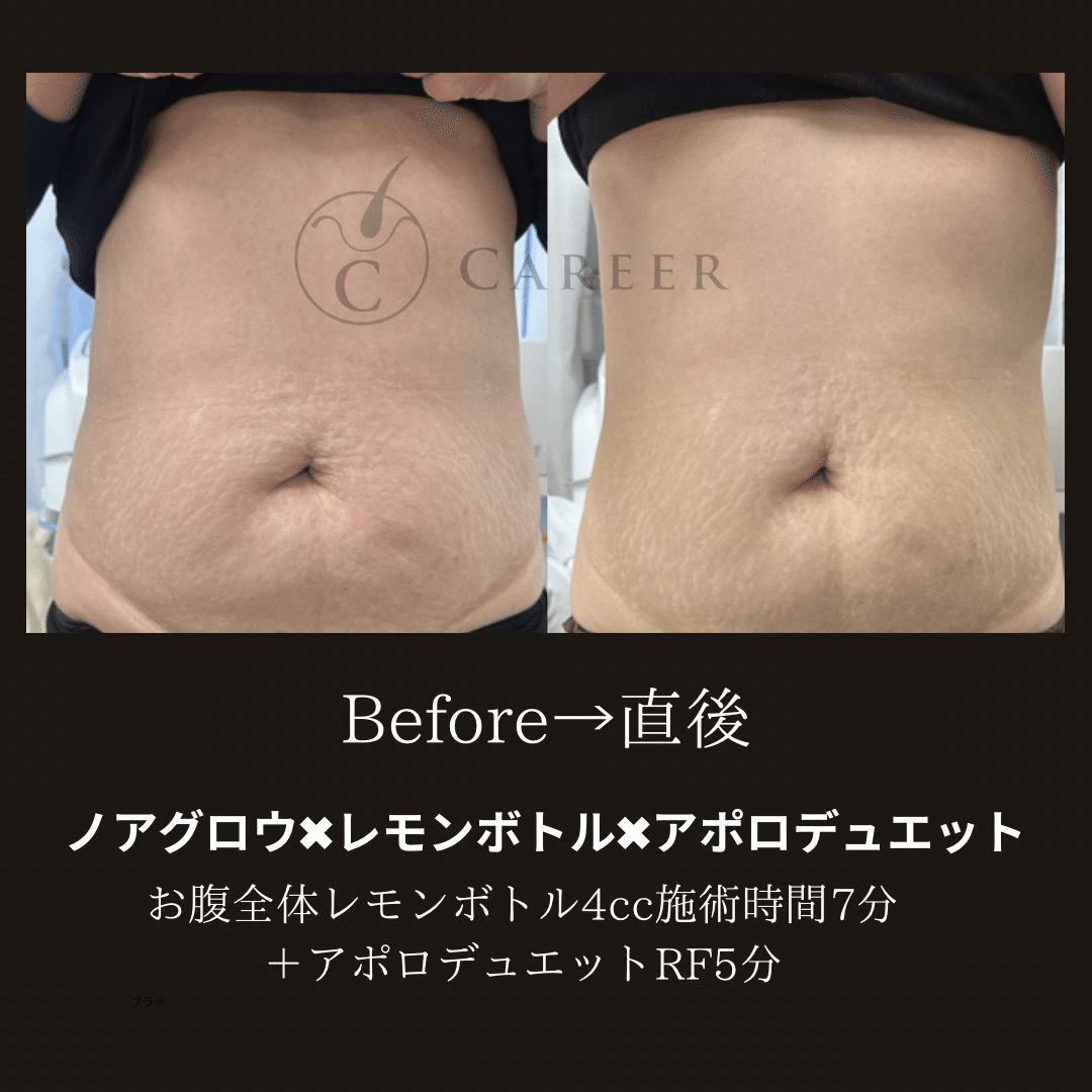 ノアグロウでのレモンボトル施術攻略法｜_career_Maiko