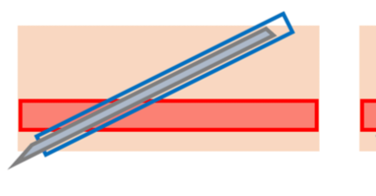 貫通法での末梢血管確保｜Yuri