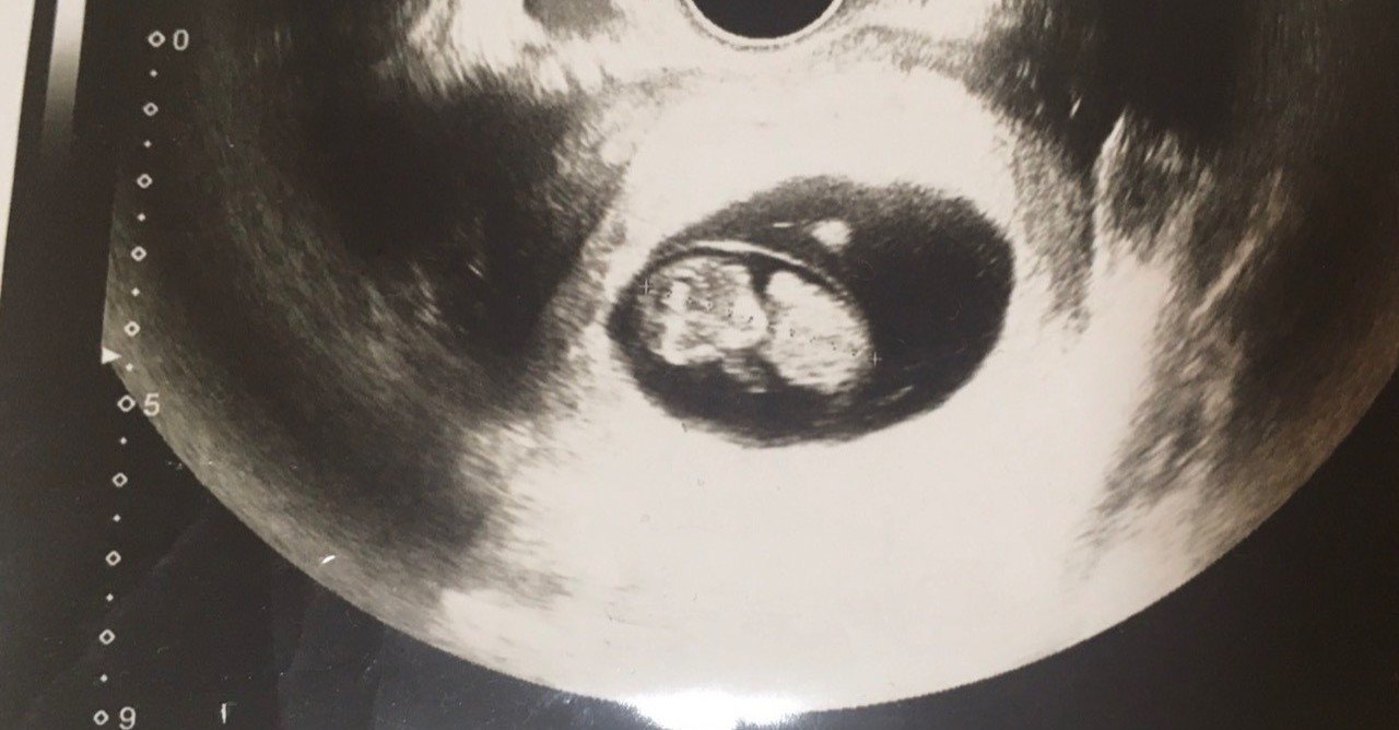 妊娠6週目 の新着タグ記事一覧 Note つくる つながる とどける