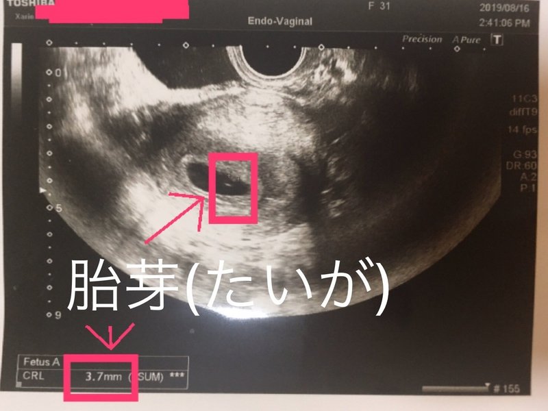 実録 胎嚢確認後 心拍確認 妊婦体験ブログ 3 第5週4日 第6週2日 激励マダム まお Private Memo Note