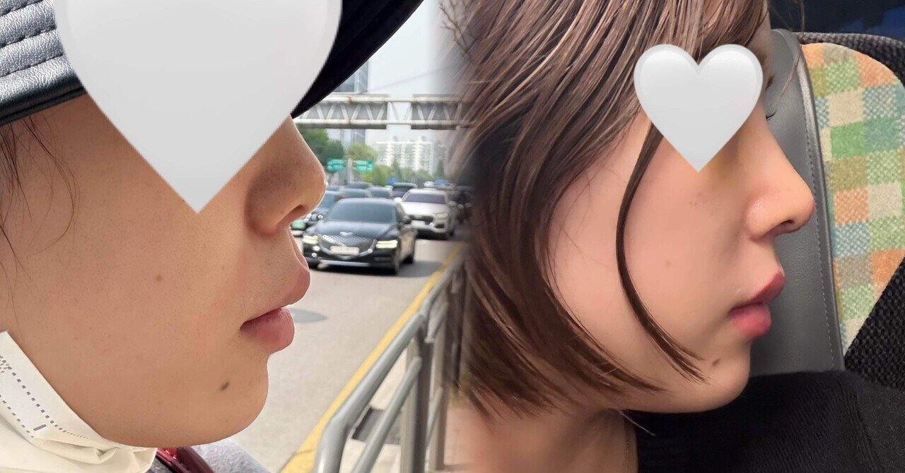 鼻先軟骨結びの施術・口コミ・クリニック情報(2026) | カンナムオンニ, image size:1280x670