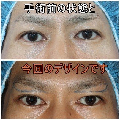 瞼のたるみをとって 若返り効果 新宿 山本クリニック Note