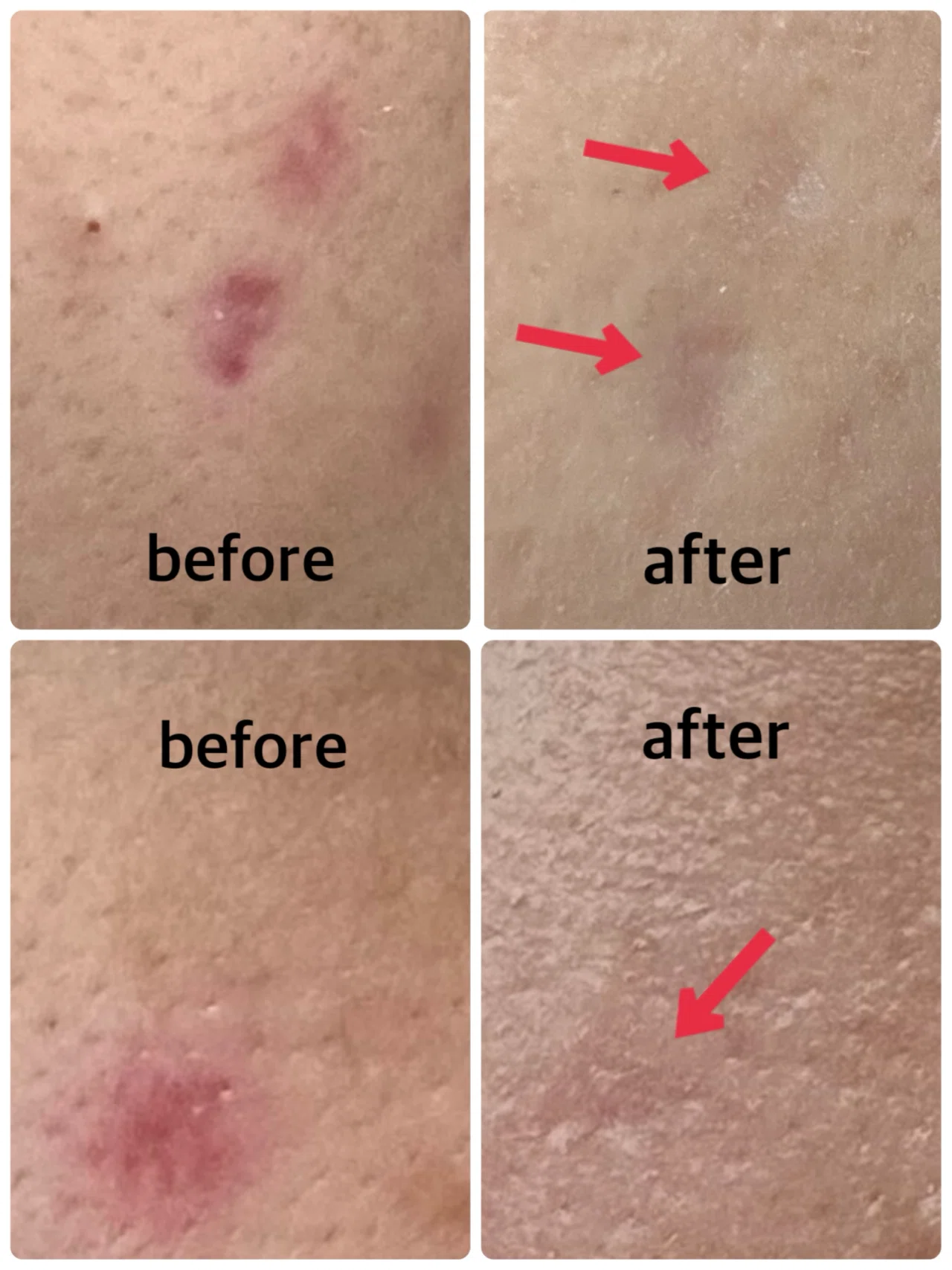 Recommended Dermatologists Skilled in V-Beam (Redness, Rosacea ...