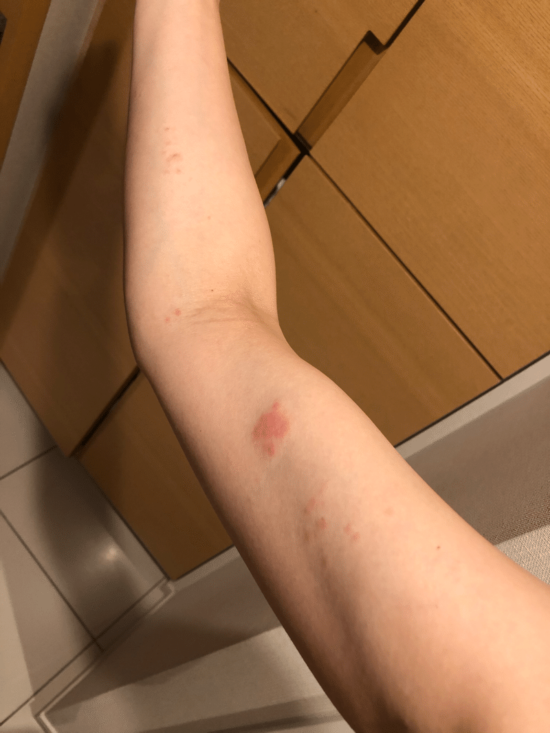 帯状疱疹 になって気付いた 感情 が体に及ぼす影響 朝井れいか 経絡整体師 おっぱい番長 41歳1児母 Note