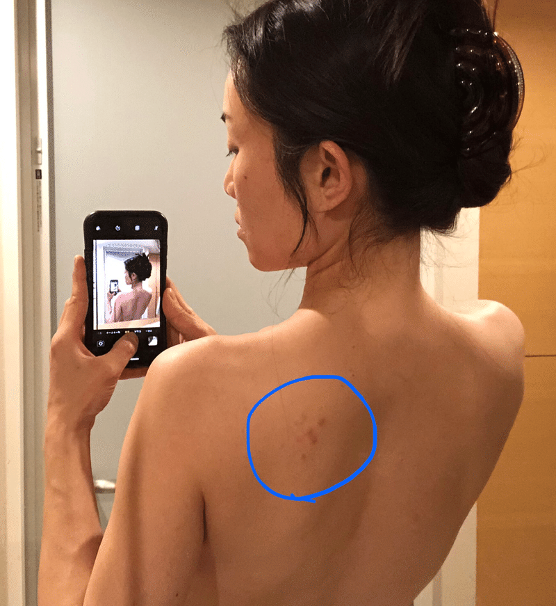 帯状疱疹 になって気付いた 感情 が体に及ぼす影響 朝井麗華 経絡整体師 おっぱい番長 41歳1児母 Note 帯状疱疹 になって気付いた 感情 が体に及ぼす影響 朝井麗華 経絡整体師 おっぱい番長 41歳1児母 Note