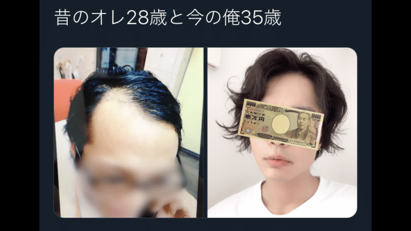 毛根が死ぬ前に アラサーから始めるハゲ治療 特殊なルートにより超格安で1日後にはフサフサになれる極意 けんちゃんねる Note 毛根が死ぬ前に アラサーから始めるハゲ治療 特殊なルートにより超格安で1日後にはフサフサになれる極意 けんちゃんねる Note
