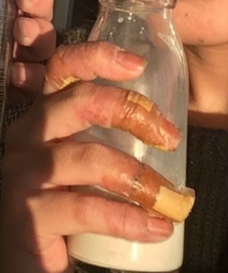 ひどい手荒れをこうやって治した 結局なにがいいの ステロイド剤は危険ではない 実体験 まつん Note ひどい手荒れをこうやって治した 結局なにがいいの ステロイド剤は危険ではない 実体験 まつん Note