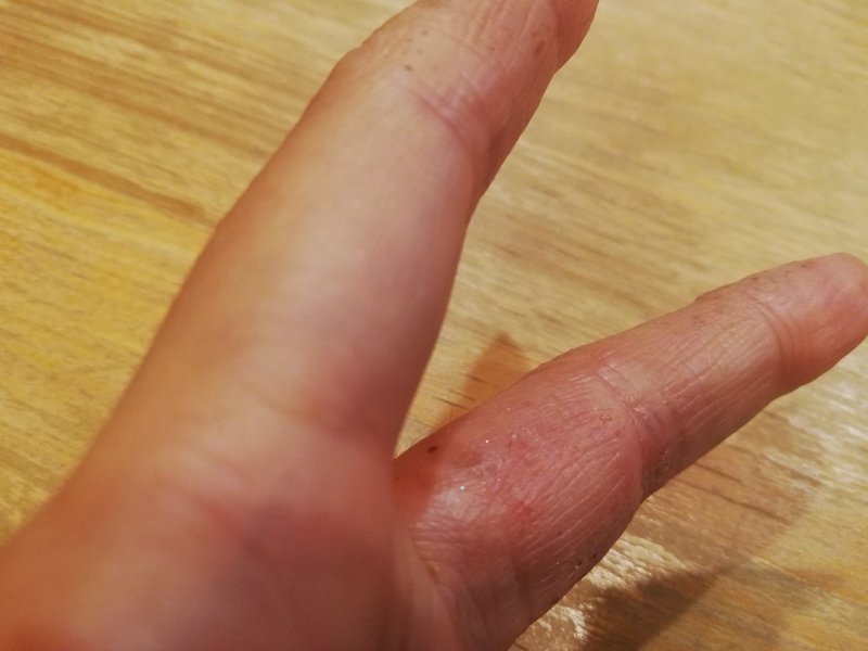 ひどい手荒れをこうやって治した 結局なにがいいの ステロイド剤は危険ではない 実体験 まつん Note ひどい手荒れをこうやって治した 結局なにがいいの ステロイド剤は危険ではない 実体験 まつん Note