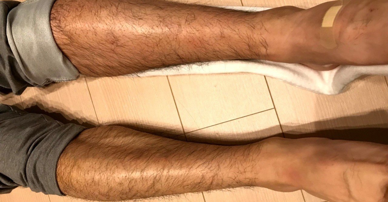 突然の脛骨骨折 受傷2日目 シロ35 Note