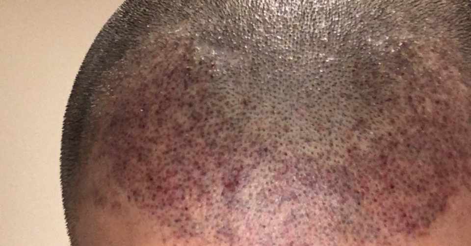 ヘアタトゥーで僕のように50万無駄にする前にお読み下さい ヘアタトゥーを検討中のあなたへ はっとり Note