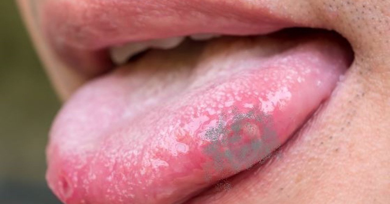 舌がんの初期症状は 歯医者さんでも口内炎と見分けがつかない Uebayashi Note