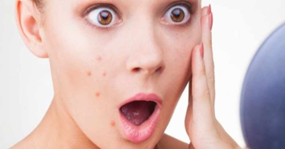 ニキビ跡の消し方 うさぎ猫 Note