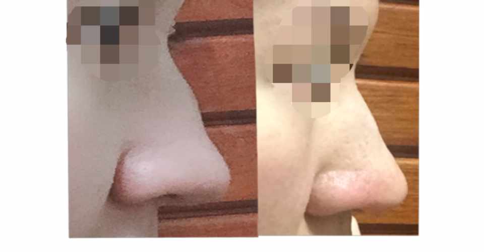 整形なしで鷲鼻を綺麗にする方法 こちらは美人を量産するアカウントです Yuuna Note