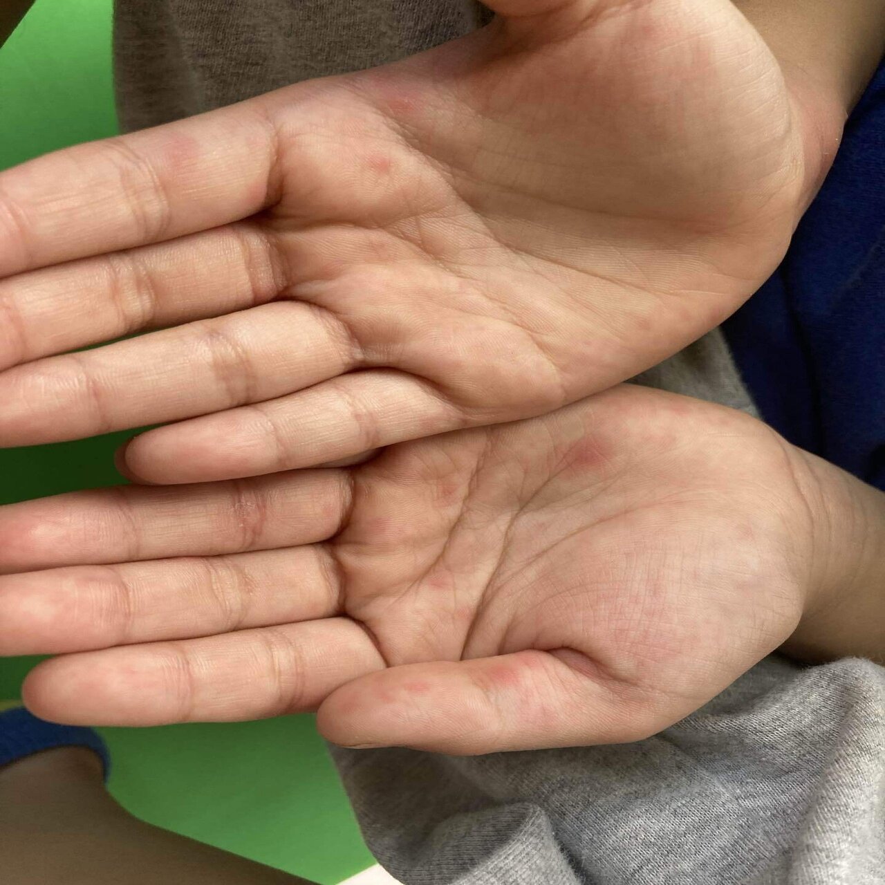 手足口病って“シンガポール病”⁇ ｜バリ島の知らなくていいコト vol.11｜Marin in Bali