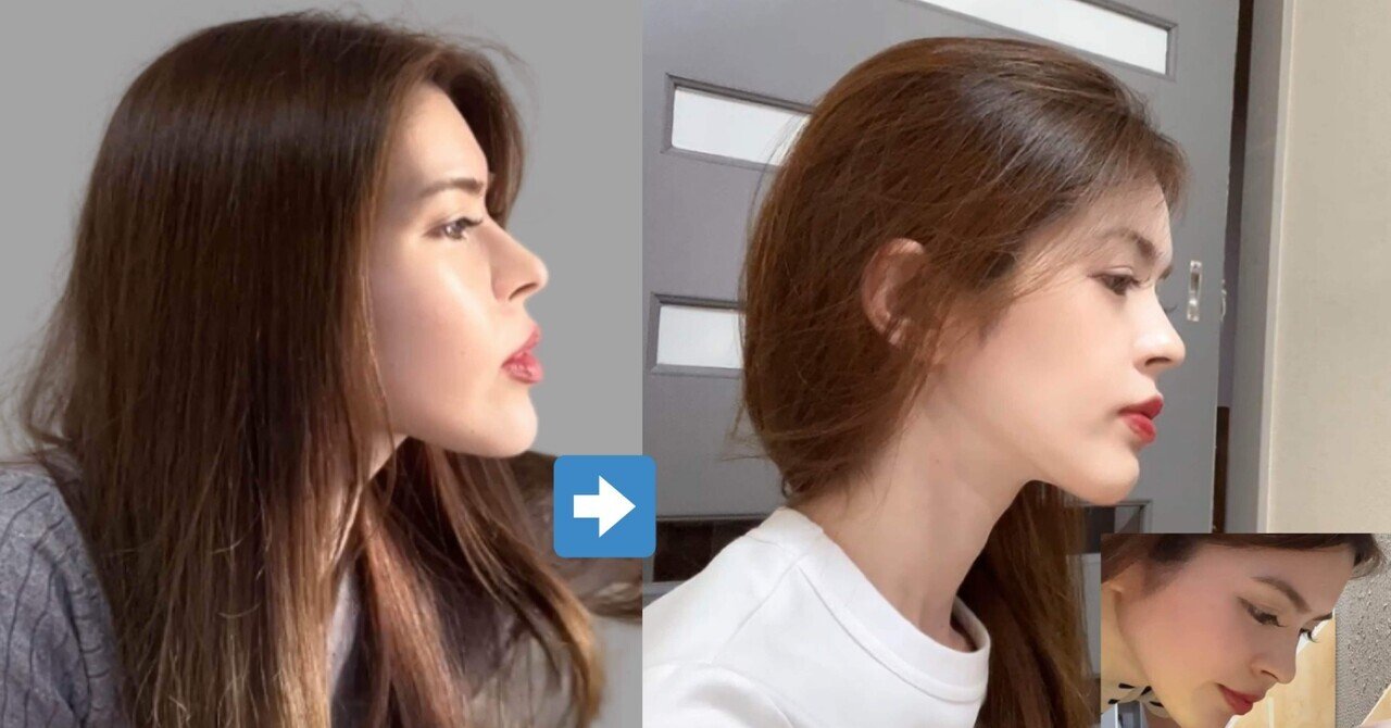 顎変形症 両顎手術（矯正歯科医と執刀医記載あり）｜石田アイラ