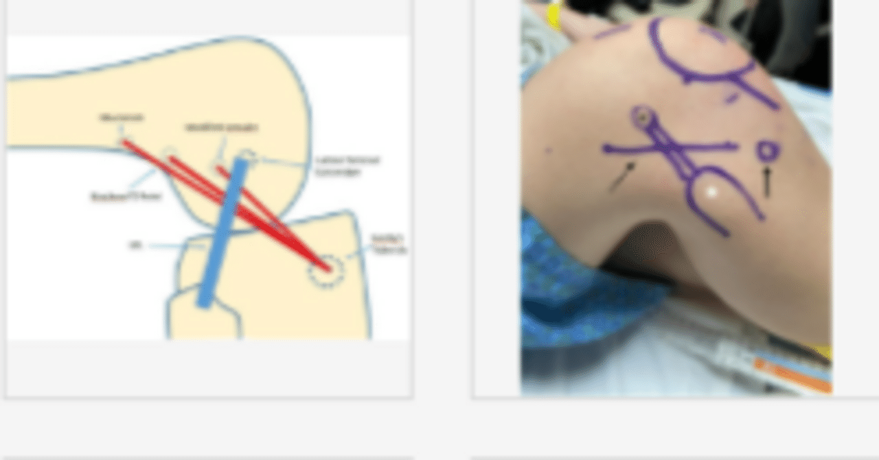 ACL再建時の関節外補強の功罪｜Brain storm conditioning 〜 脳から