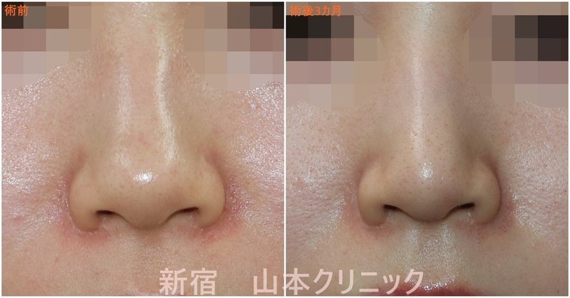 鼻尖形成術 団子鼻手術 だけだと アップノーズになるよ 新宿 山本クリニック Note