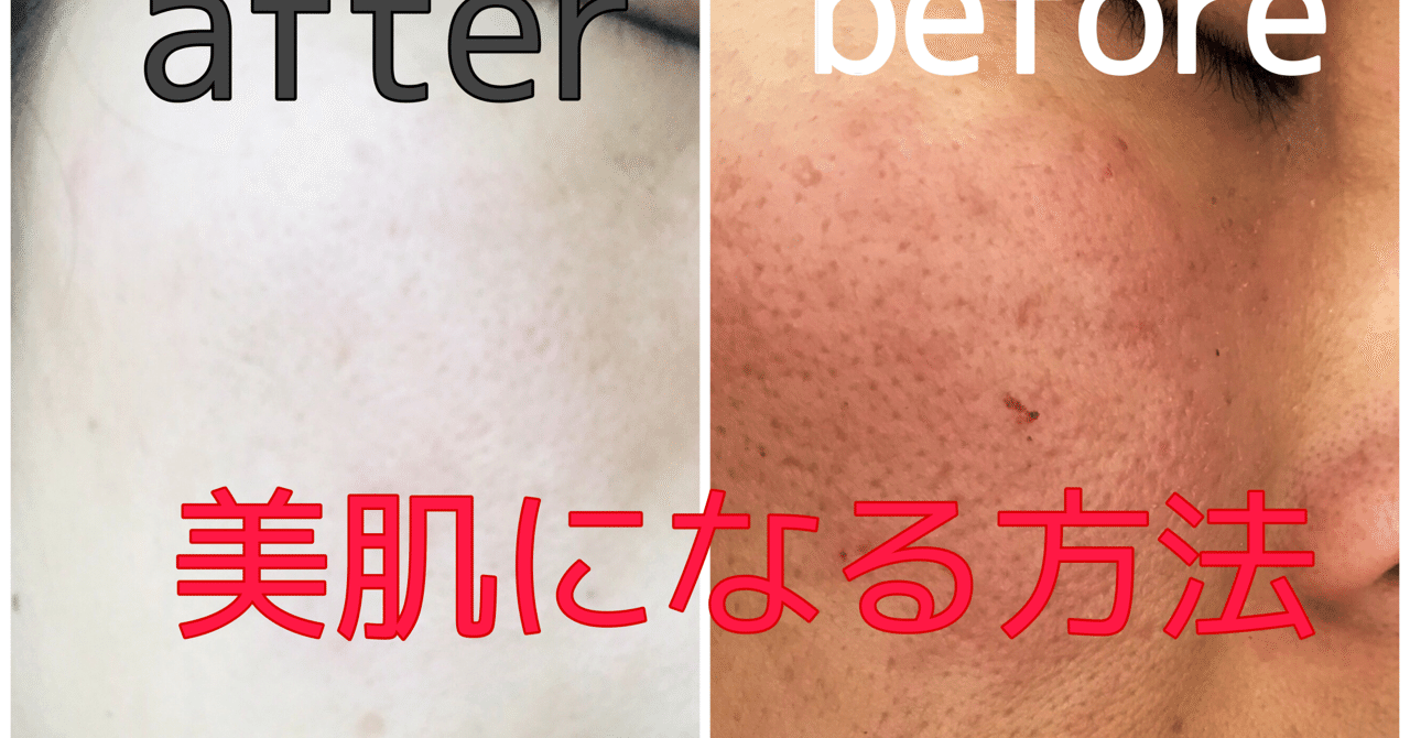 ニキビ跡クレーター の新着タグ記事一覧 Note つくる つながる とどける