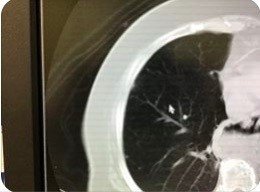 アセトアミノフェン肝障害肺CT
