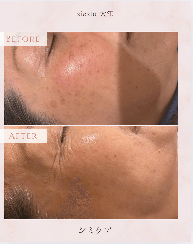 最新型の低周波ペンシルでシミケア｜Siesta shanti佐藤香奈子