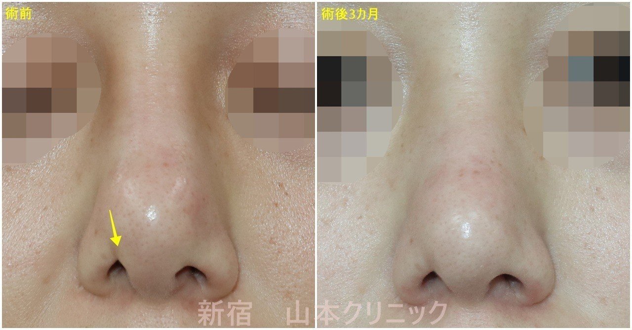 鼻プロテーゼ シリコン 抜いたら 簡単に元に戻る 新宿 山本クリニック Note