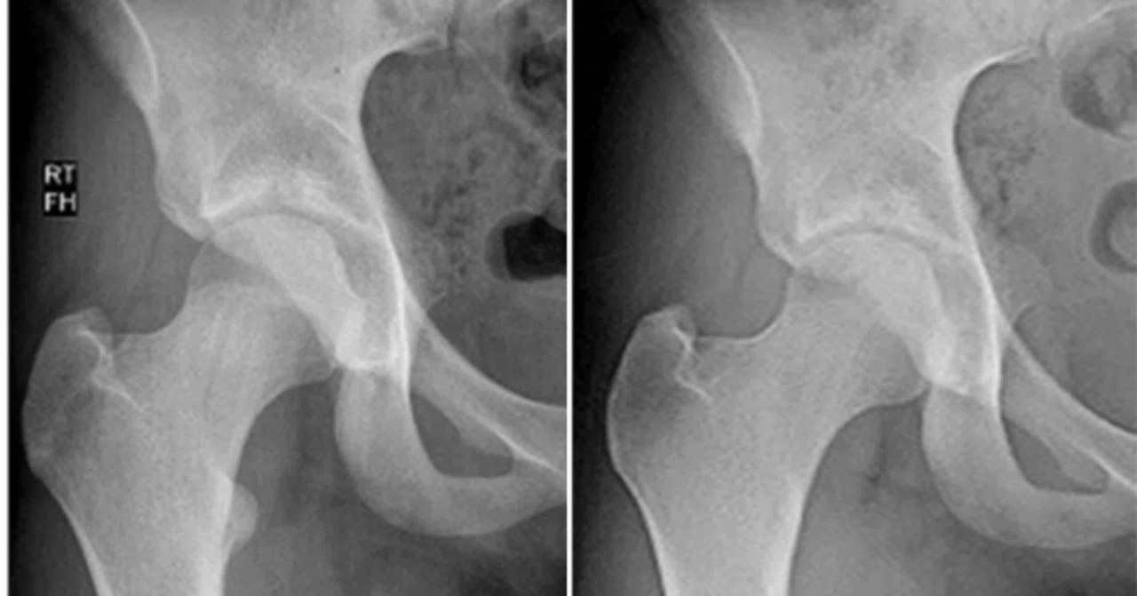坐骨大腿インピンジメントの治療：診断的注射と小転子の関節鏡下切除の