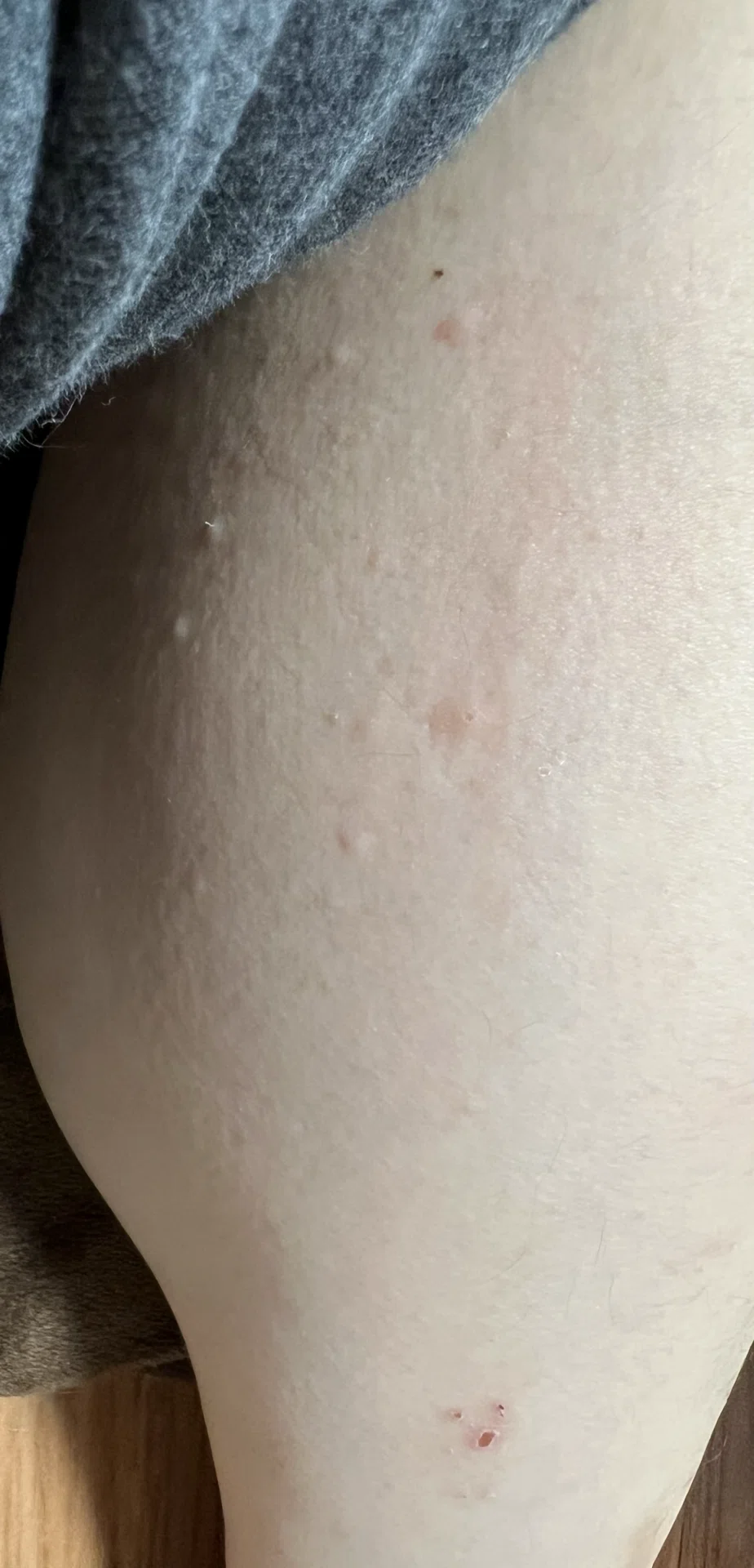Different Face Rashes My Introduction to Malignant Lymphoma (Hodgkin Lymphoma)|げそ天@体力食欲オバケながん患者