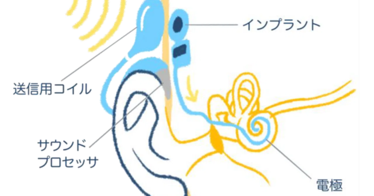 人工内耳の電極選択の考え方（2025年）｜南 修司郎