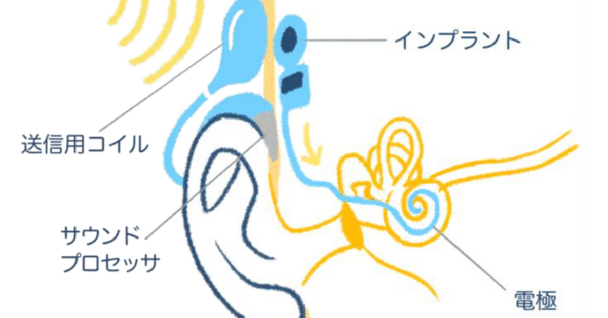 人工内耳 人工内耳の電極選択の考え方（2025年）｜南 修司郎