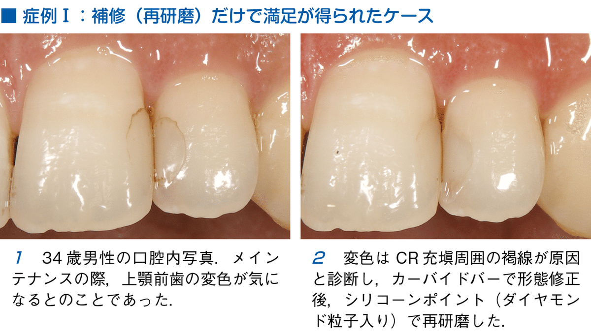 ⚠裁断済　そうだったのか!CR(コンポジットレジン)修復 : CR修復に悩んで… ⚠裁断済 そうだったのか!CR(コンポジットレジン)修復 : CR修
