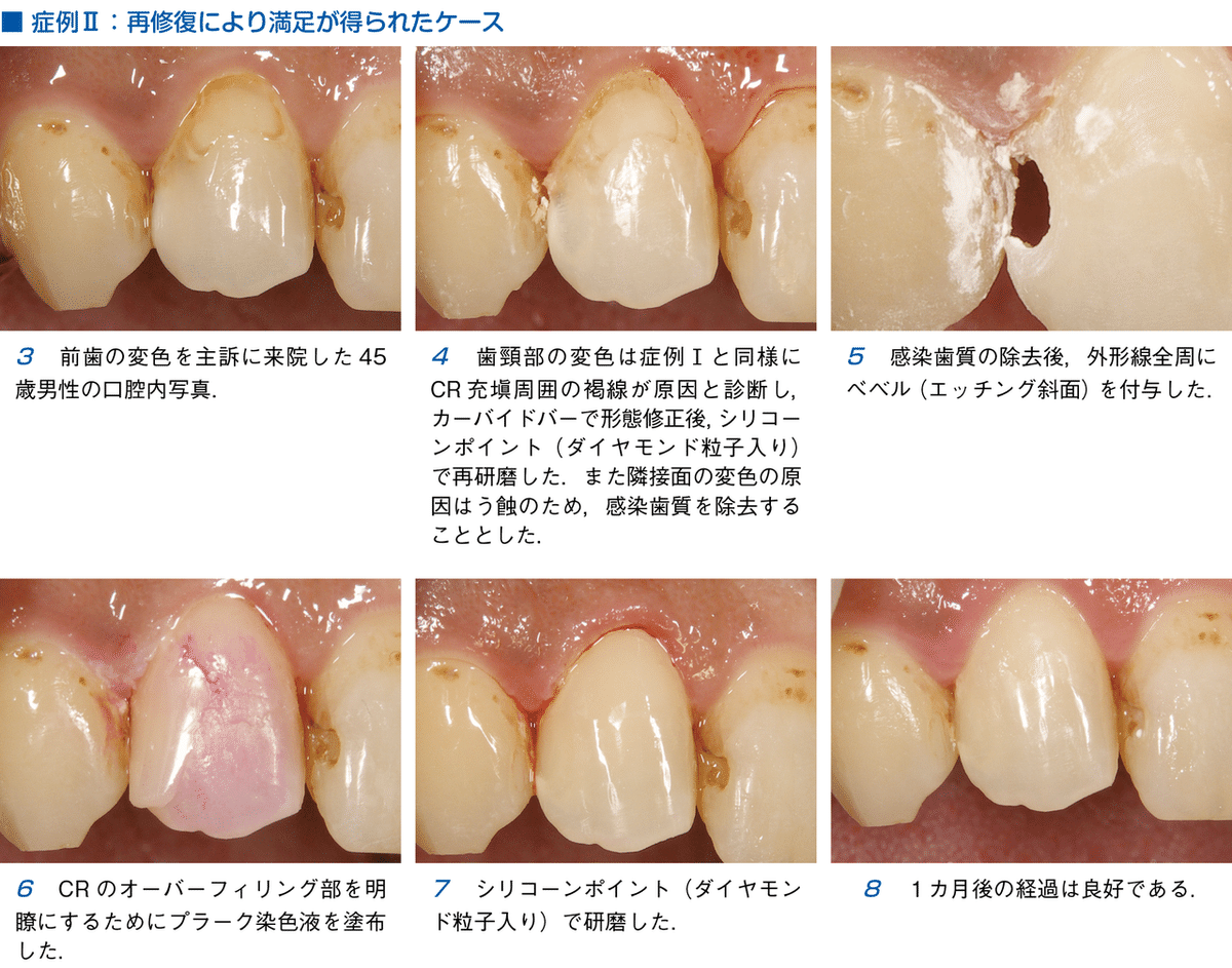 須崎 明・著『そうだったのか！ CR修復』より―見て見ぬふり