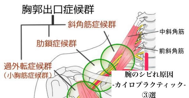 上肢の運動器疾患に対する評価と治療 ＜狭窄性腱鞘炎と胸郭出口症候群＞ 上肢の運動器疾患に対する評価と治療＜狭窄性腱鞘炎と胸郭出口
