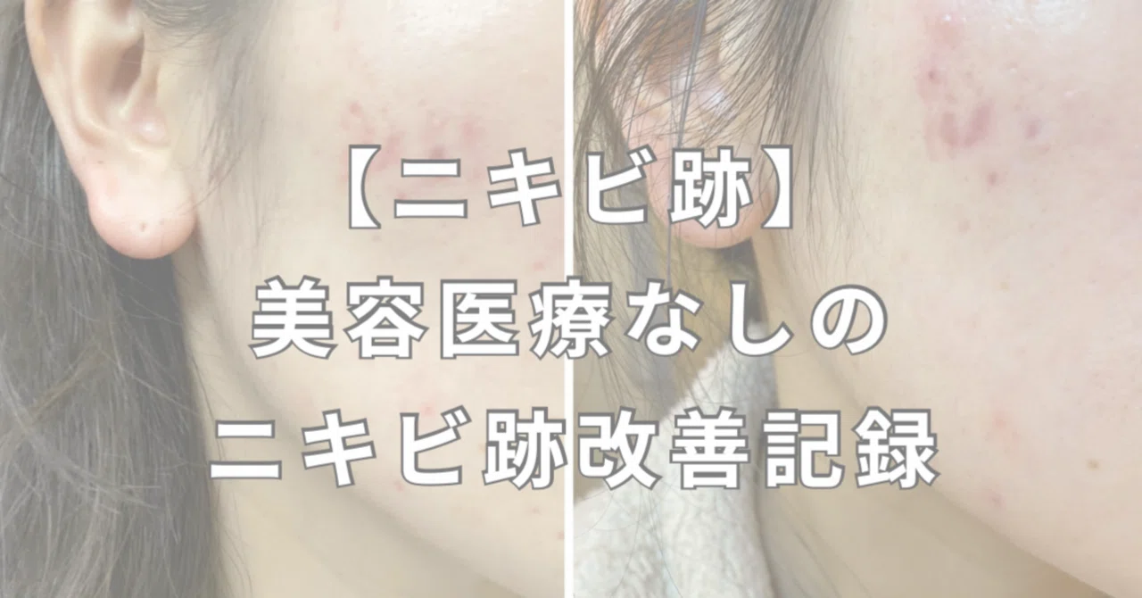 [Acne Scars] A Record of Improving Acne Scars Without Cosmetic ...