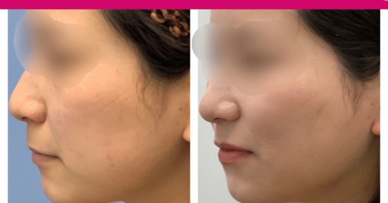 ほほアゴ下脂肪吸引モニター 湘南美容クリニック多田彩子 Note