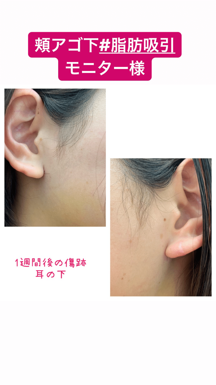 ほほアゴ下脂肪吸引モニター 湘南美容クリニック多田彩子 Note ほほアゴ下脂肪吸引モニター 湘南美容クリニック多田彩子 Note