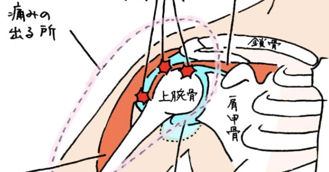 五十肩の悩みをシェアしたい その3｜go_goats_go