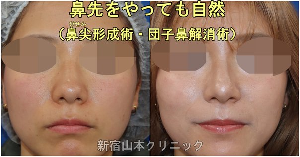 【裁断済】鼻形成術　ジョン・ジェヨン 鼻形成術 Rebuilding Nose | 鄭載用(ジョン・ジェヨン), Jaeyong