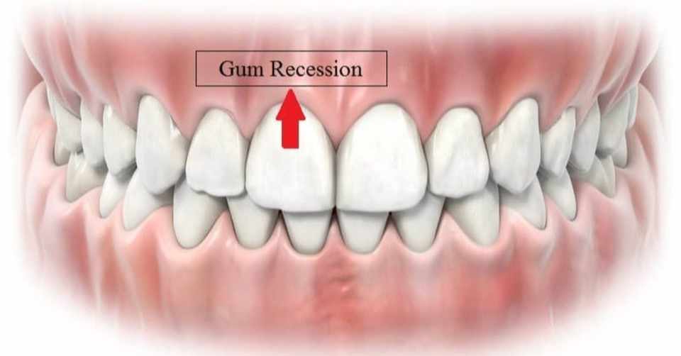 Can You Repair Receding Gums Naturally Craig Garrett Note