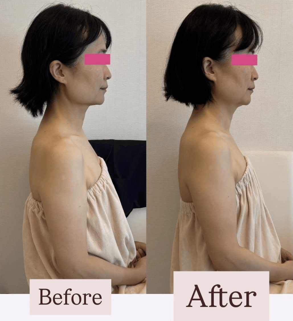 エラ削ってません。なのに骨も変わる？！【ビフォーアフター】｜エラ