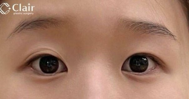 形成外科1年生〜まずはここから、おすすめの本〜4.眼瞼手術｜DR.YOU