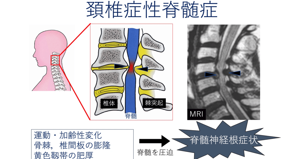 圧迫性脊髄症（頚椎症性脊髄症）とは｜成田渉・患者様に役立つ