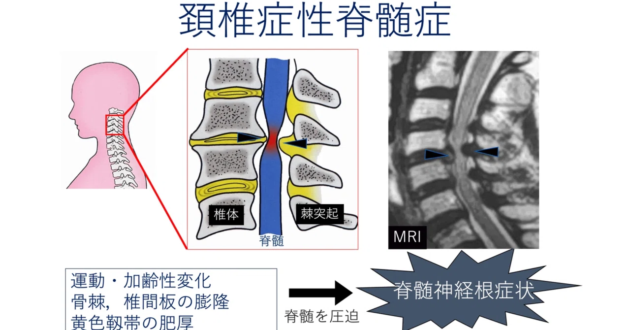 圧迫性脊髄症（頚椎症性脊髄症）とは｜【頸椎執刀数/本邦最多級