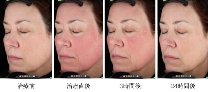 ピコレーザーの種類と特徴 効果のある機器について徹底解説 くちびるガビガビ Note