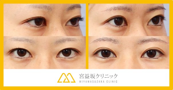 眼瞼手術チャレンジノート 専修医石嶋くんの眼瞼手術チャレンジノート
