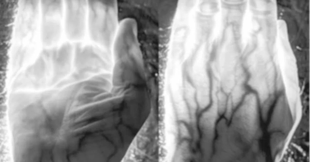 Long Wavelengths of Sunlight Pass Through the Human Body and Improve ...